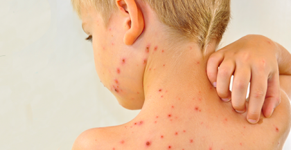 HEALTH AUTHORITIES ANTICIPATES MEASLES OUTBREAK item-thumbnail